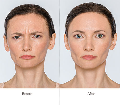 Cosmetic Botox before and after